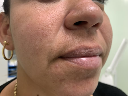 micropigmentación de labios