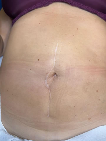 seguridad para la micropigmentación de cicatrices en Las Palmas