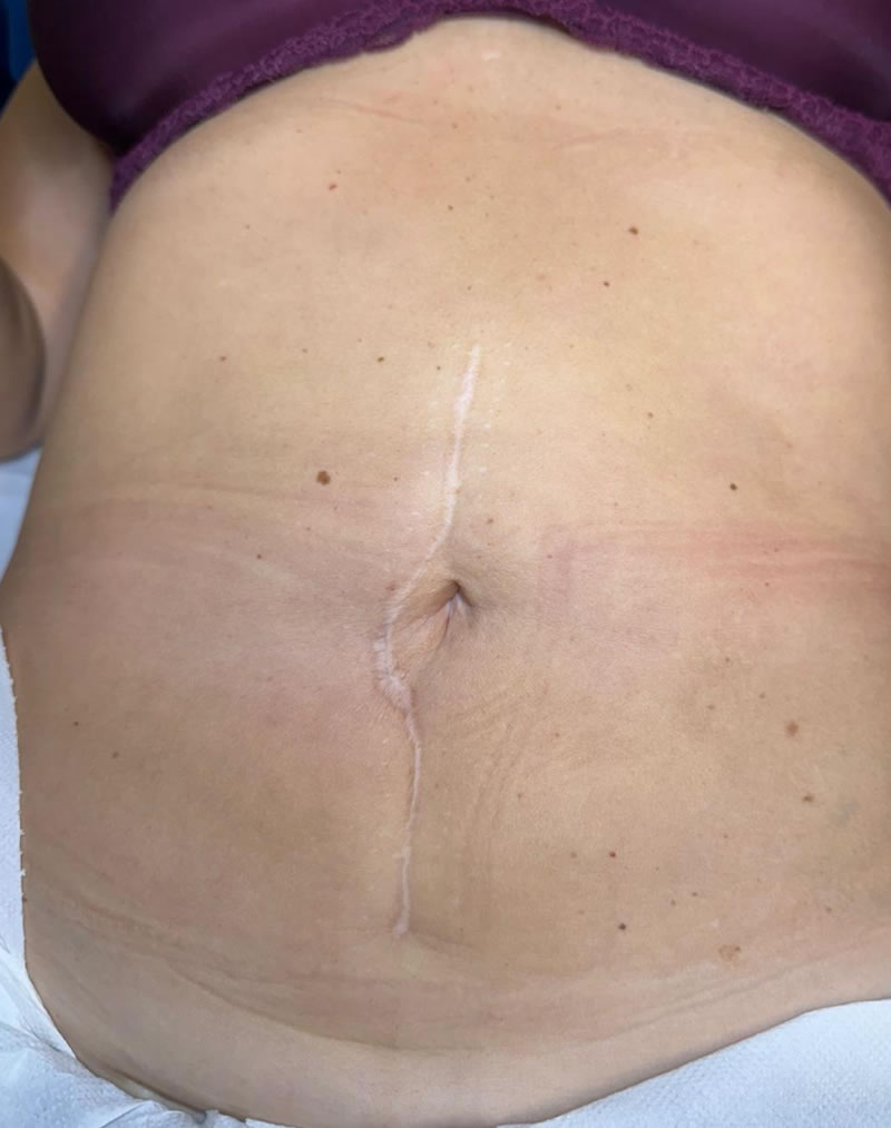 seguridad para la micropigmentación de cicatrices en Las Palmas