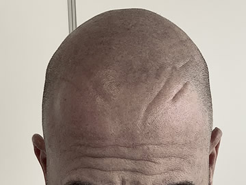 micropigmentación capilar en Las Palmas