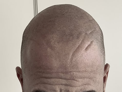 micropigmentación capilar en Las Palmas