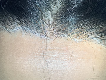 Micropigmentación de Cicatrices en Las Palmas